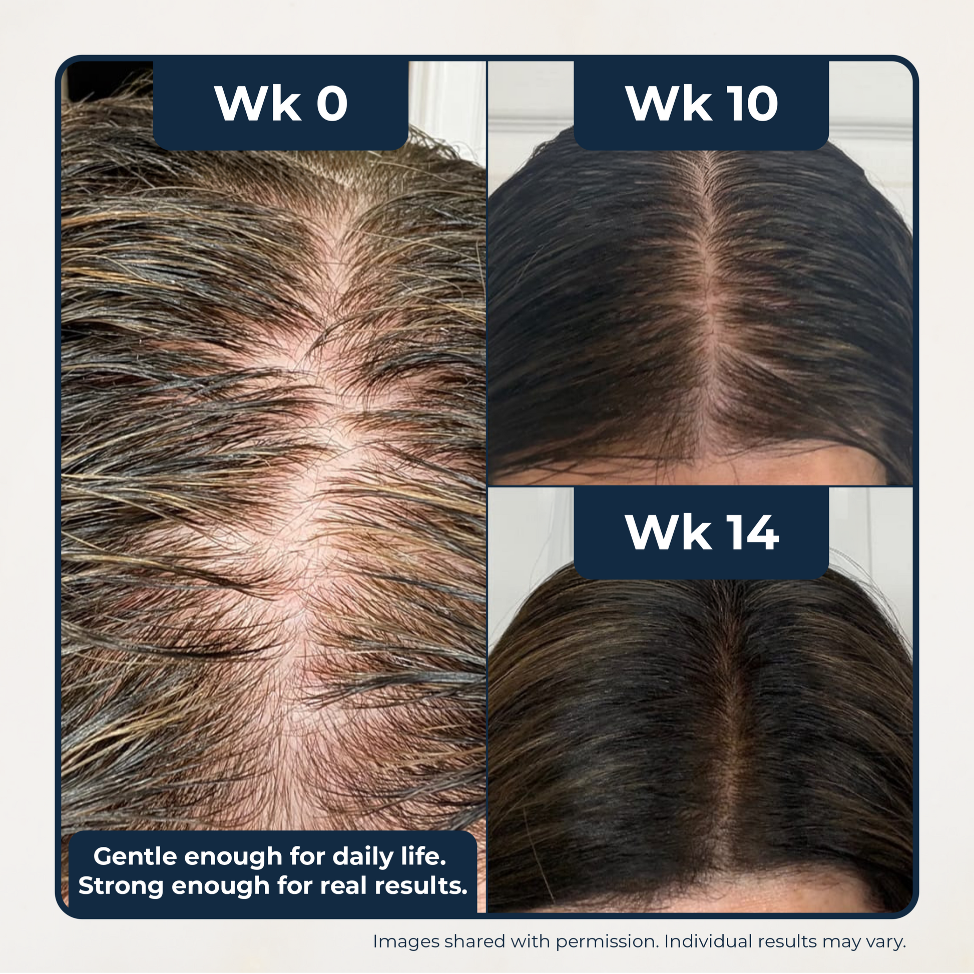 Before and after images showing hair growth progress over 14 weeks using peptide rich shampoo for itchy scalp.